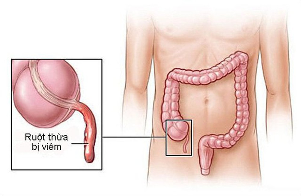 Dấu Hiệu Đau Ruột Thừa