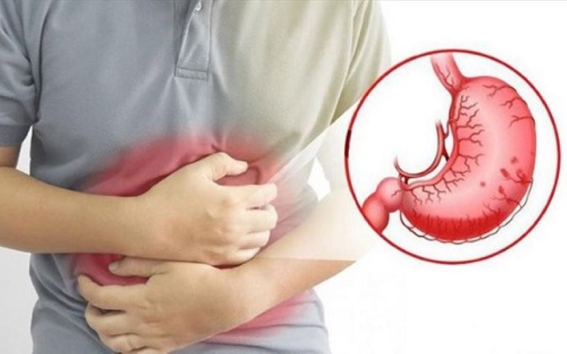 Nguyên nhân và cách phòng ngừa, chữa trị bệnh đau dạ dày(đau bao tử)