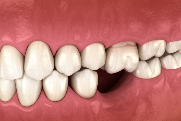 Tác hại của mất răng