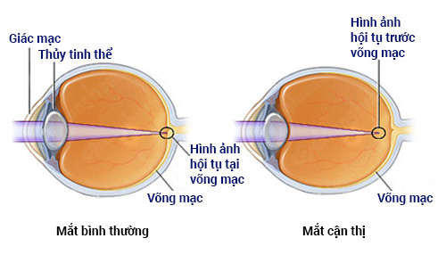 Cận thị học đường đang có xu hướng tăng cao-420-1