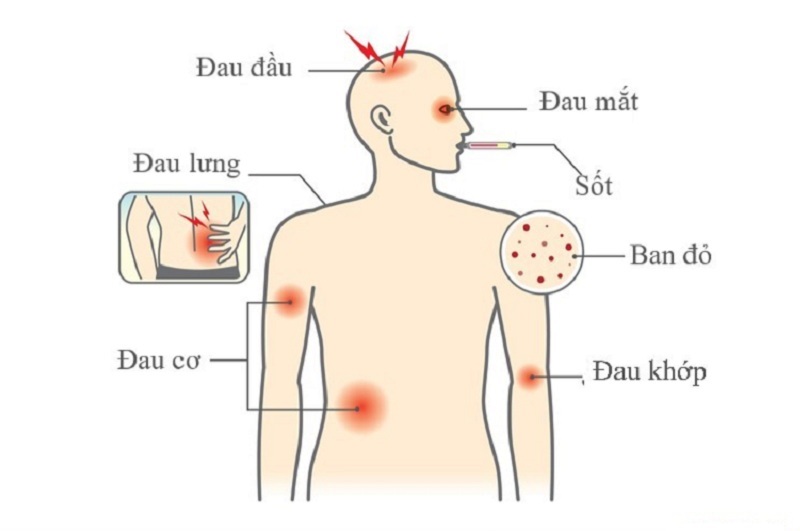 Dấu Hiệu Sớm Của Sốt Xuất Huyết - Bệnh Truyền Nhiễm Nguy Hiểm-760-1