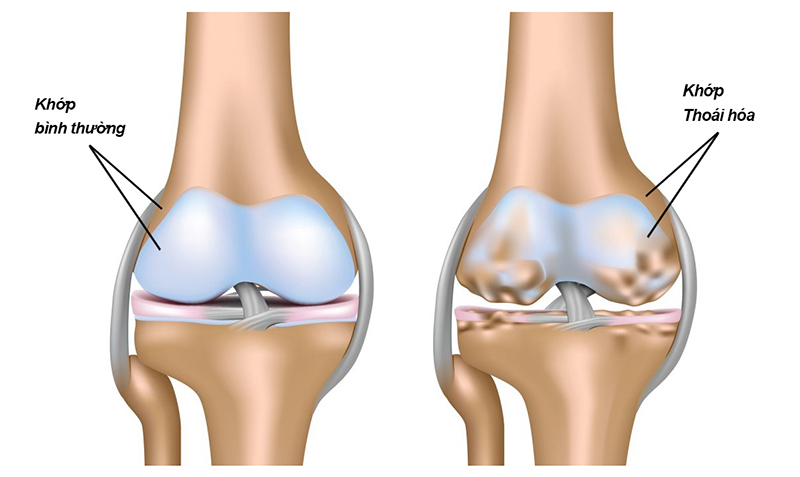 Thoái Hóa Khớp: Nguyên Nhân Và Cách Điều Trị Ở Người Cao Tuổi-958-1