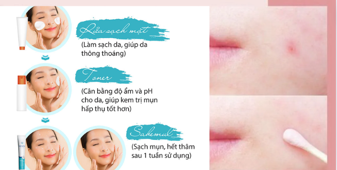 Kem Chấm Mụn: Những Điều Cần Biết Để Có Một Làn Da Sáng Mịn Không Mụn-881-1