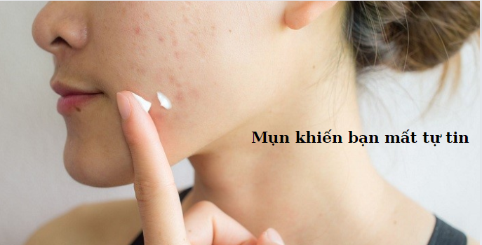 Kem Chấm Mụn: Những Điều Cần Biết Để Có Một Làn Da Sáng Mịn Không Mụn-881-1