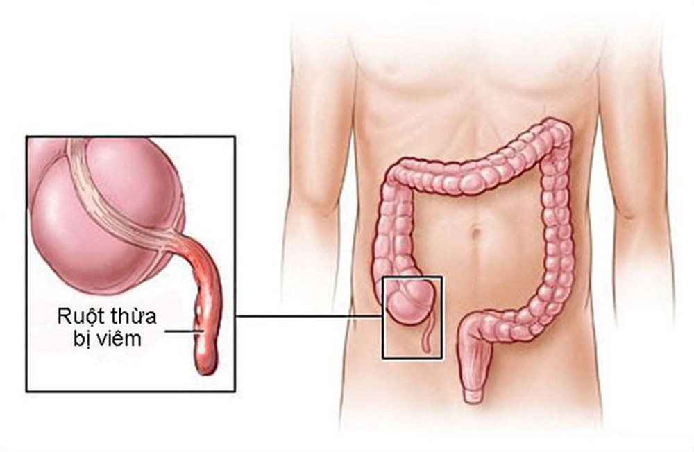 Ăn hạt ổi có bị đau ruột thừa hay không?-439-1