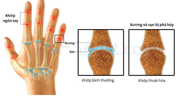 Thoái Hóa Khớp: Nguyên Nhân Và Cách Điều Trị Ở Người Cao Tuổi-1